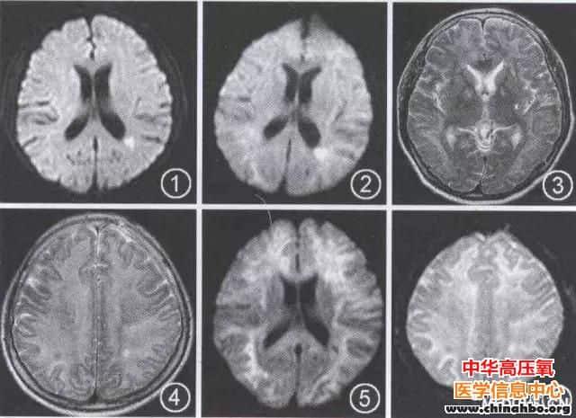 持续4年多的煤气中毒后遗症仍有治愈的机会