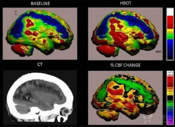 PLoS ONE：高压氧治疗利于卒中患者康复