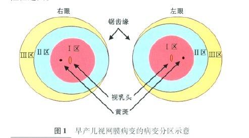 高压氧治疗请关注早产儿和低体重儿——中国早产儿视网膜病变筛查指南（2014 年）