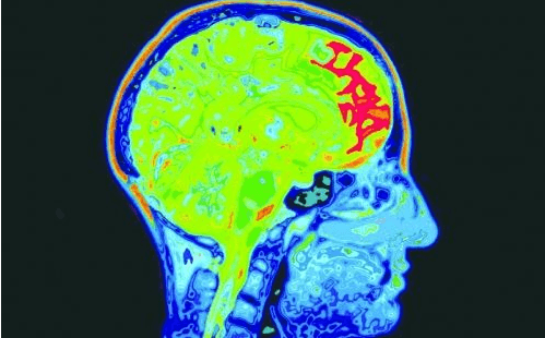 不会也吃个人吧？——对抗痴呆，科学家向食人族“取经”