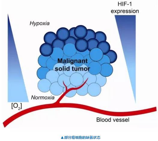 Nature子刊：“闷死”肿瘤的抗癌新策略