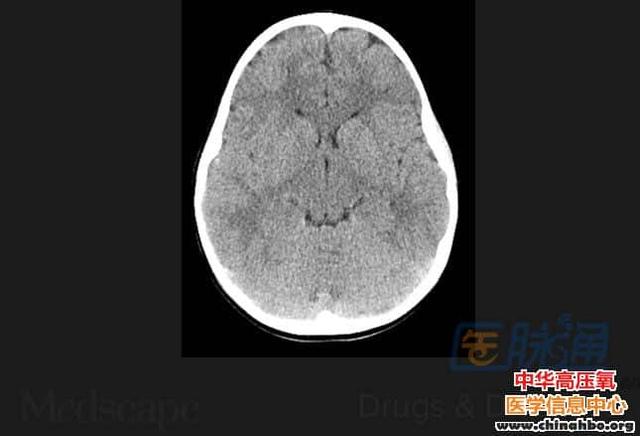 轻度脑损伤后光靠成像就可以预测结果