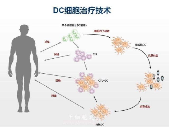 改善癌症免疫疗法新途径——DC细胞抗氧化